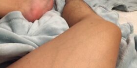 leg veins